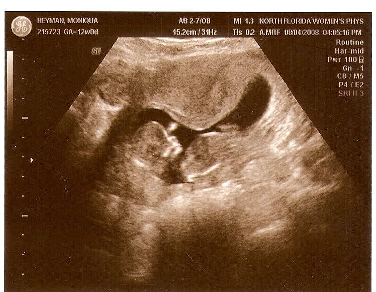 Baby Heyman at 12 weeks