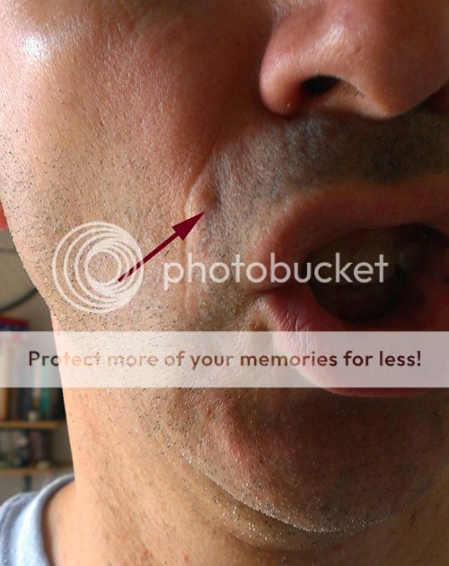 Permanent Injury? View topic Trumpet Herald forum